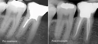 Dentist discussing wisdom tooth x-ray with patient